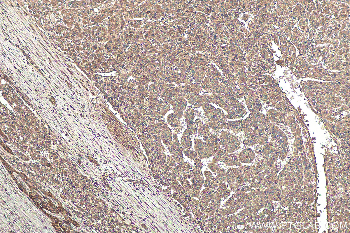 Immunohistochemical analysis of paraffin-embedded human liver cancer tissue slide using KHC0113 (TNC/Tenascin-C IHC Kit).