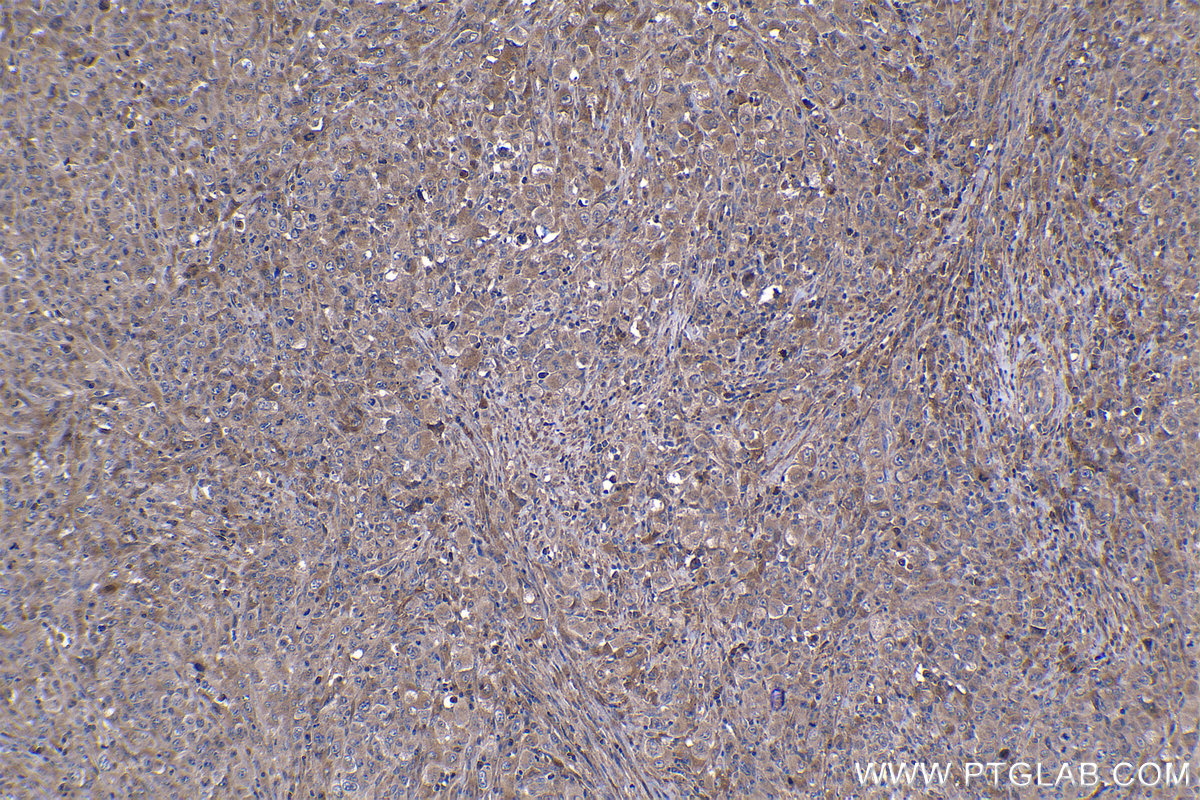 Immunohistochemical analysis of paraffin-embedded human lymphoma tissue slide using KHC1155 (TNF IHC Kit).