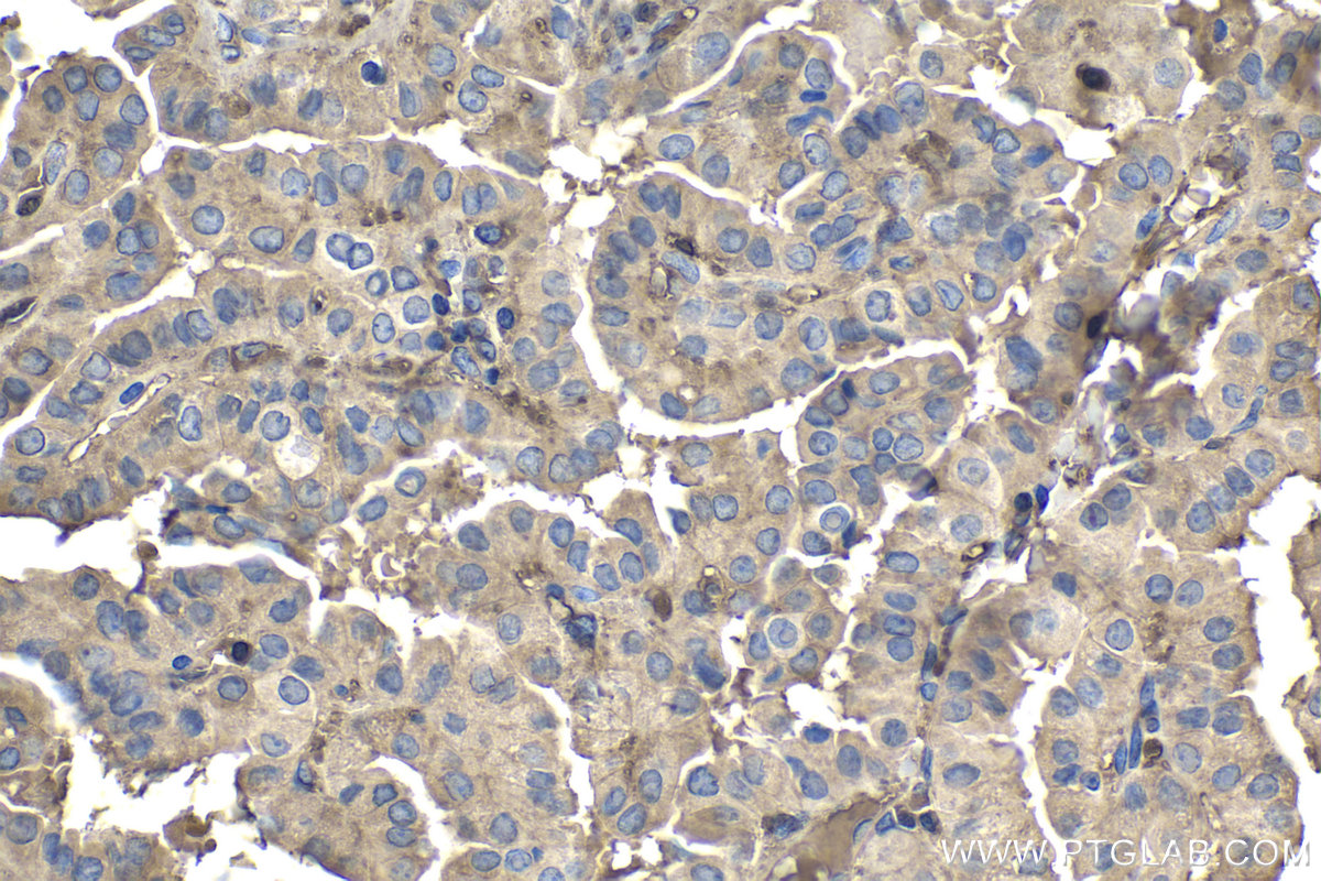 Immunohistochemical analysis of paraffin-embedded human thyroid cancer tissue slide using KHC1840 (TNIP2 IHC Kit).