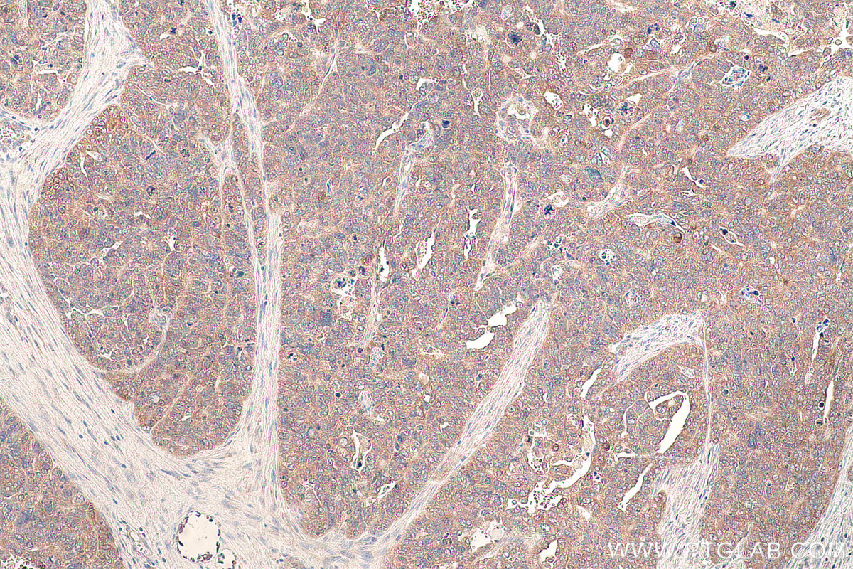 Immunohistochemical analysis of paraffin-embedded human ovary tumor tissue slide using KHC0857 (TOMM34 IHC Kit).