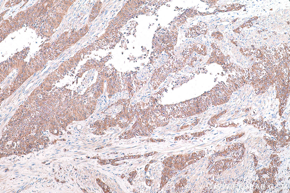 Immunohistochemical analysis of paraffin-embedded human urothelial carcinoma tissue slide using KHC0857 (TOMM34 IHC Kit).