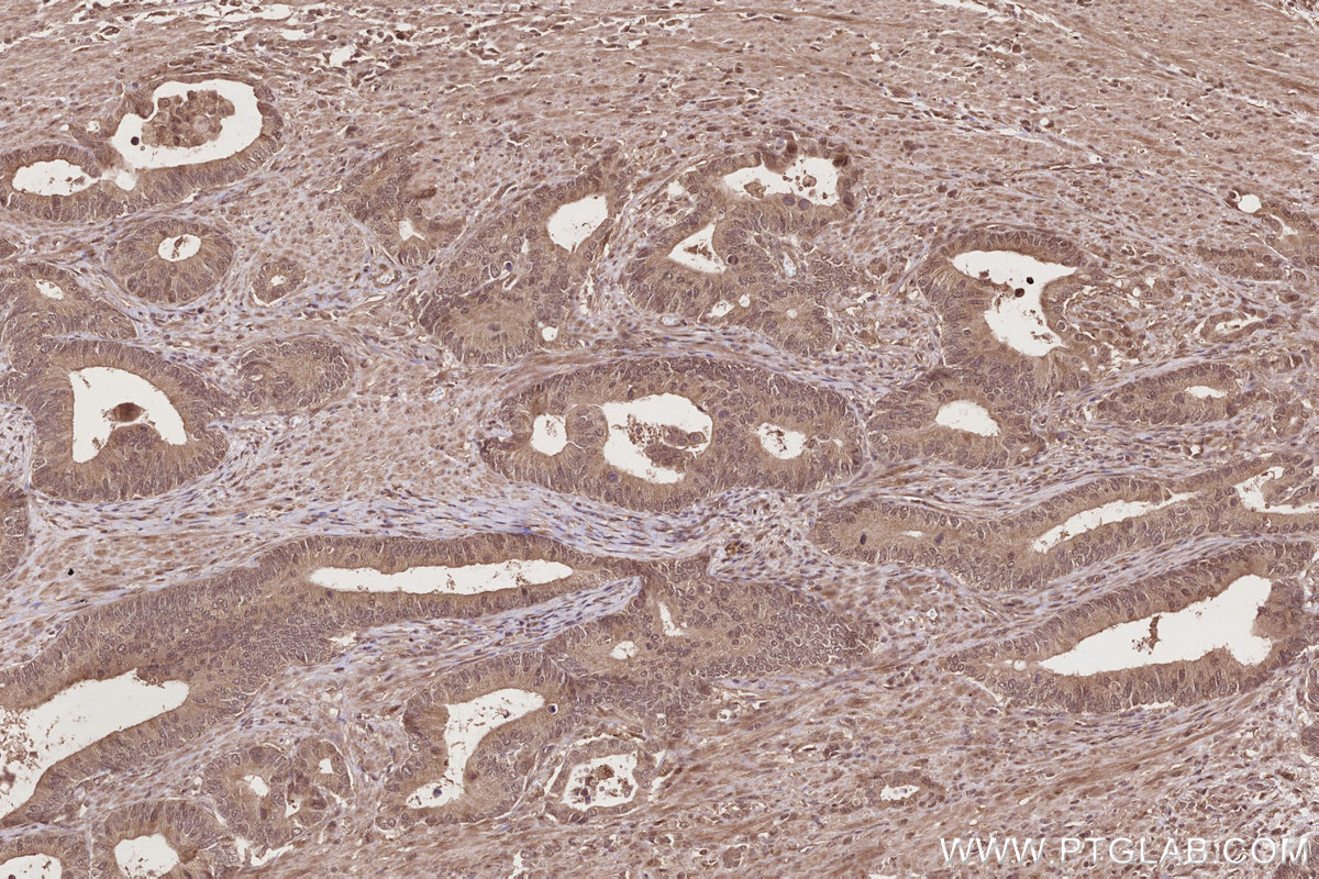 Immunohistochemical analysis of paraffin-embedded human rectal cancer tissue slide using KHC2775 (TP53INP1 IHC Kit).