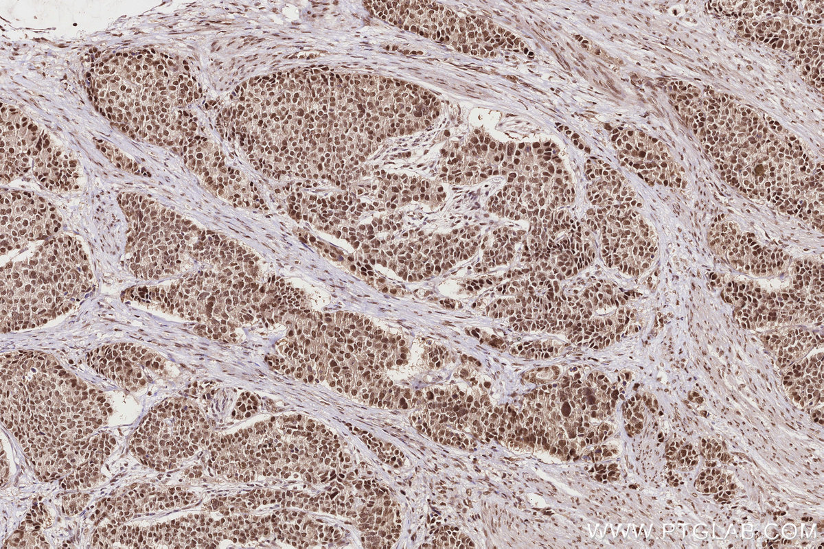 Immunohistochemical analysis of paraffin-embedded human stomach cancer tissue slide using KHC2832 (TP53RK IHC Kit).