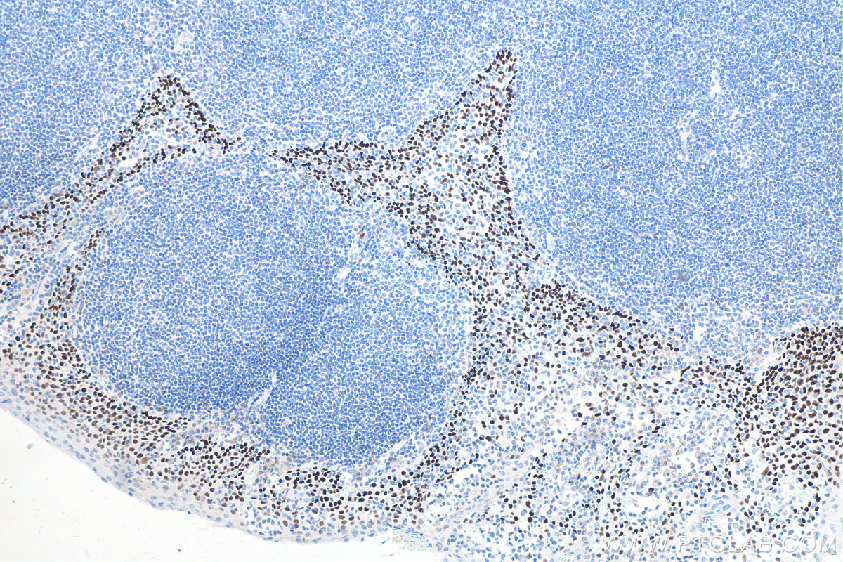 Immunohistochemical analysis of paraffin-embedded human tonsillitis tissue slide using KHC0086 (TP63 IHC Kit).