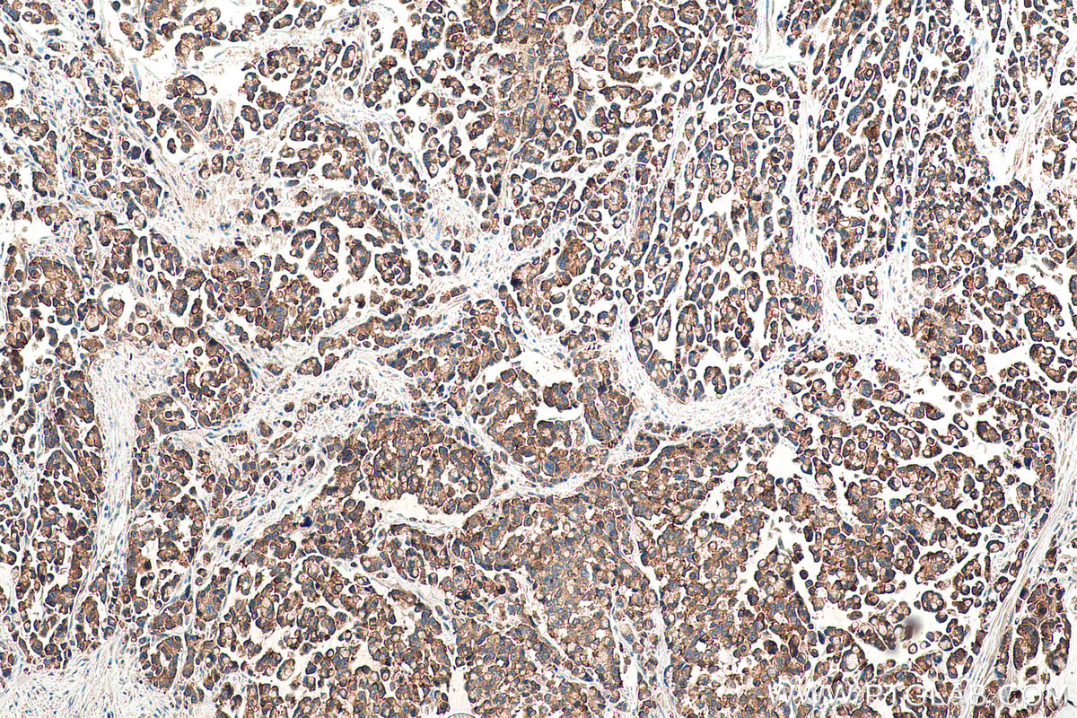 Immunohistochemical analysis of paraffin-embedded human colon cancer tissue slide using KHC0967 (TPD52L1 IHC Kit).