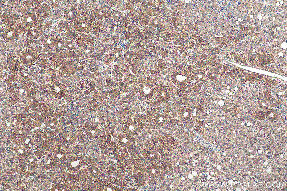 Immunohistochemical analysis of paraffin-embedded human liver cancer tissue slide using KHC0967 (TPD52L1 IHC Kit).