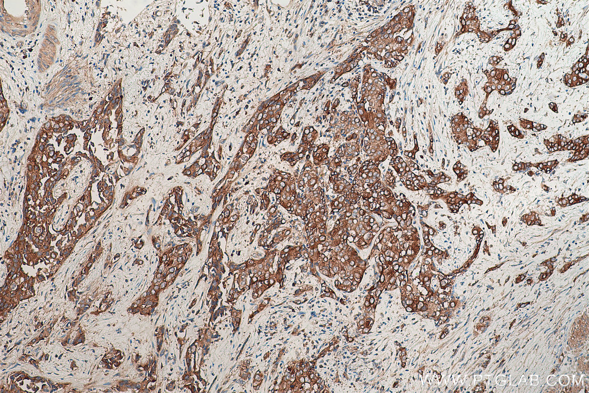 Immunohistochemical analysis of paraffin-embedded human urothelial carcinoma tissue slide using KHC0844 (TPD52L2 IHC Kit).