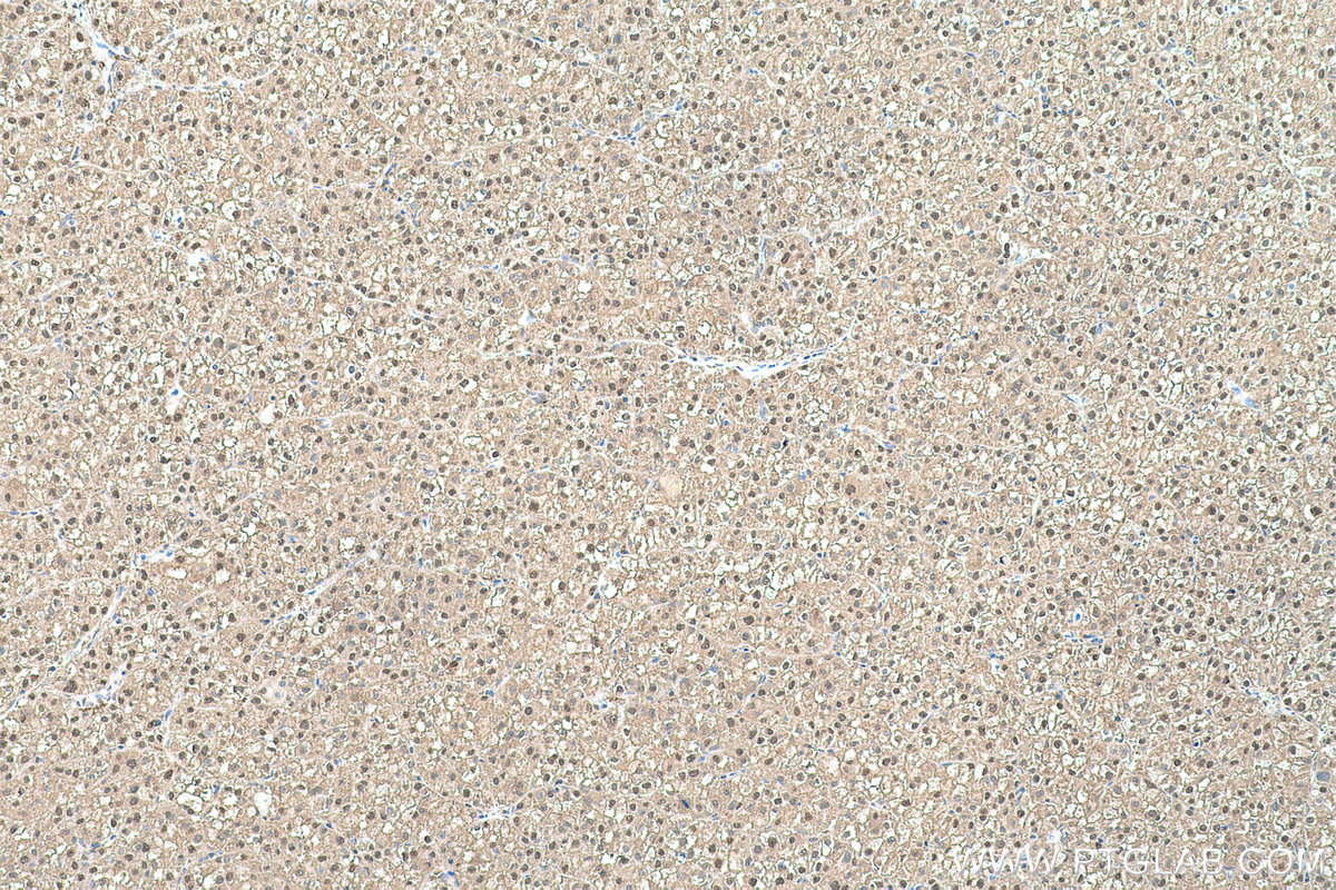 Immunohistochemical analysis of paraffin-embedded human liver cancer tissue slide using KHC0511 (TPI1 IHC Kit).