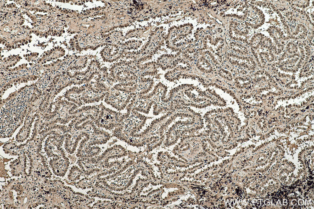 Immunohistochemical analysis of paraffin-embedded human lung cancer tissue slide using KHC0511 (TPI1 IHC Kit).