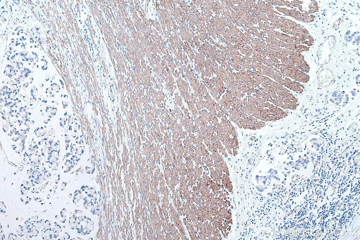 Immunohistochemical analysis of paraffin-embedded human colon cancer tissue slide using KHC0482 (TPM2 IHC Kit).