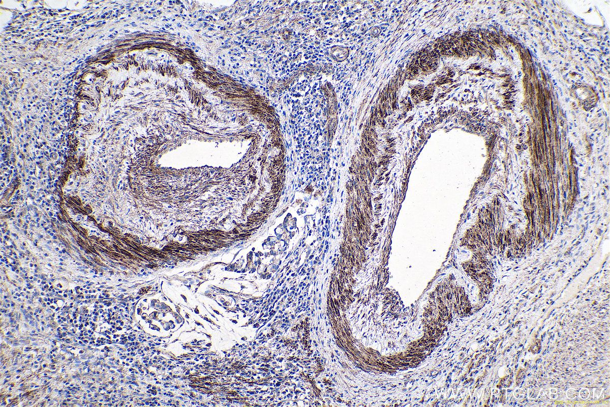 Immunohistochemical analysis of paraffin-embedded human colon cancer tissue slide using KHC0660 (TPM4 IHC Kit).