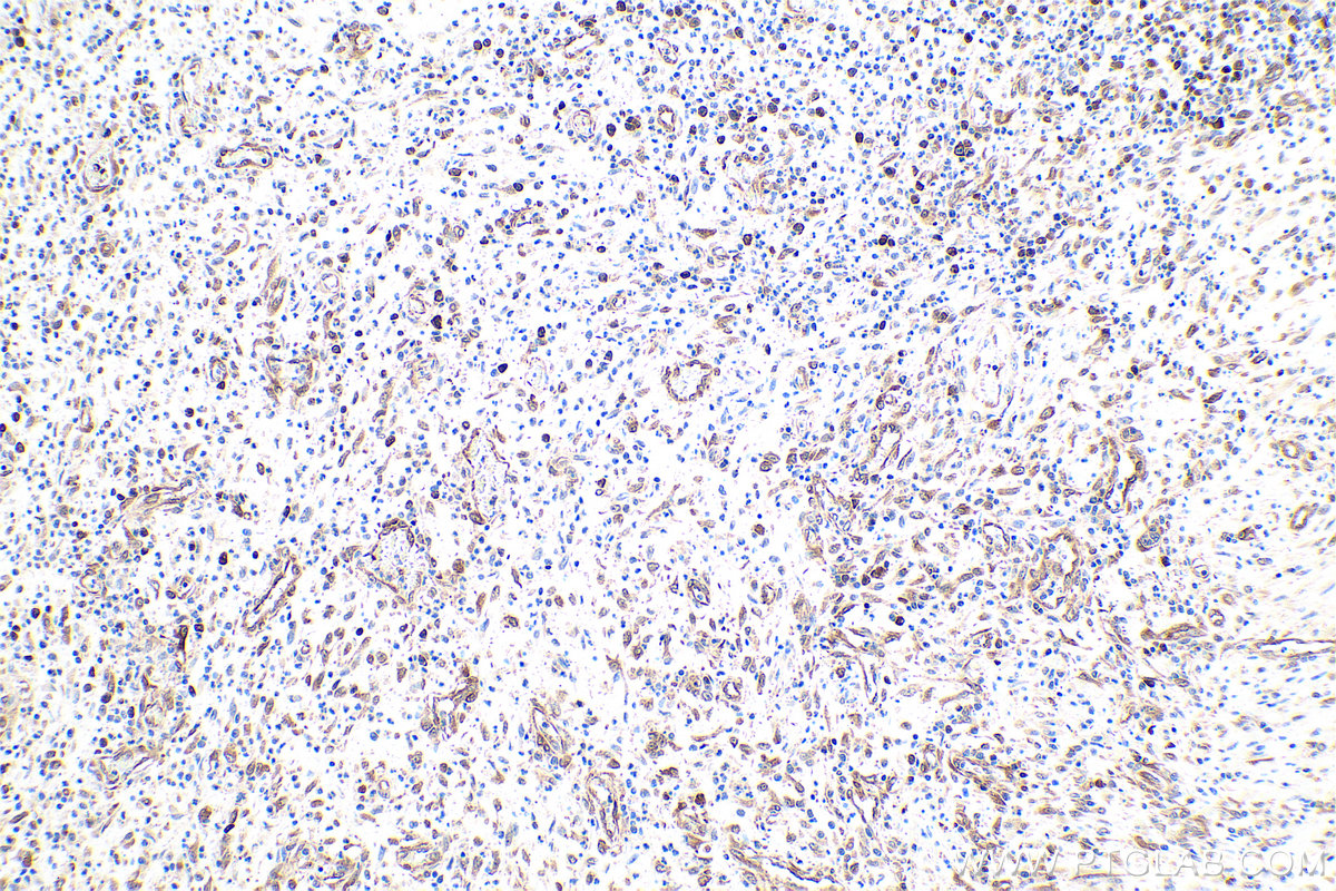 Immunohistochemical analysis of paraffin-embedded human colon cancer tissue slide using KHC0874 (TPT1 IHC Kit).