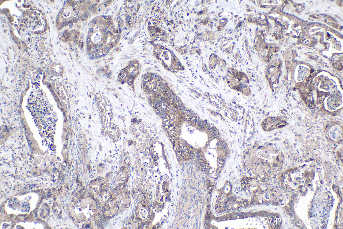 Immunohistochemical analysis of paraffin-embedded human pancreas cancer tissue slide using KHC1755 (TRADD IHC Kit).