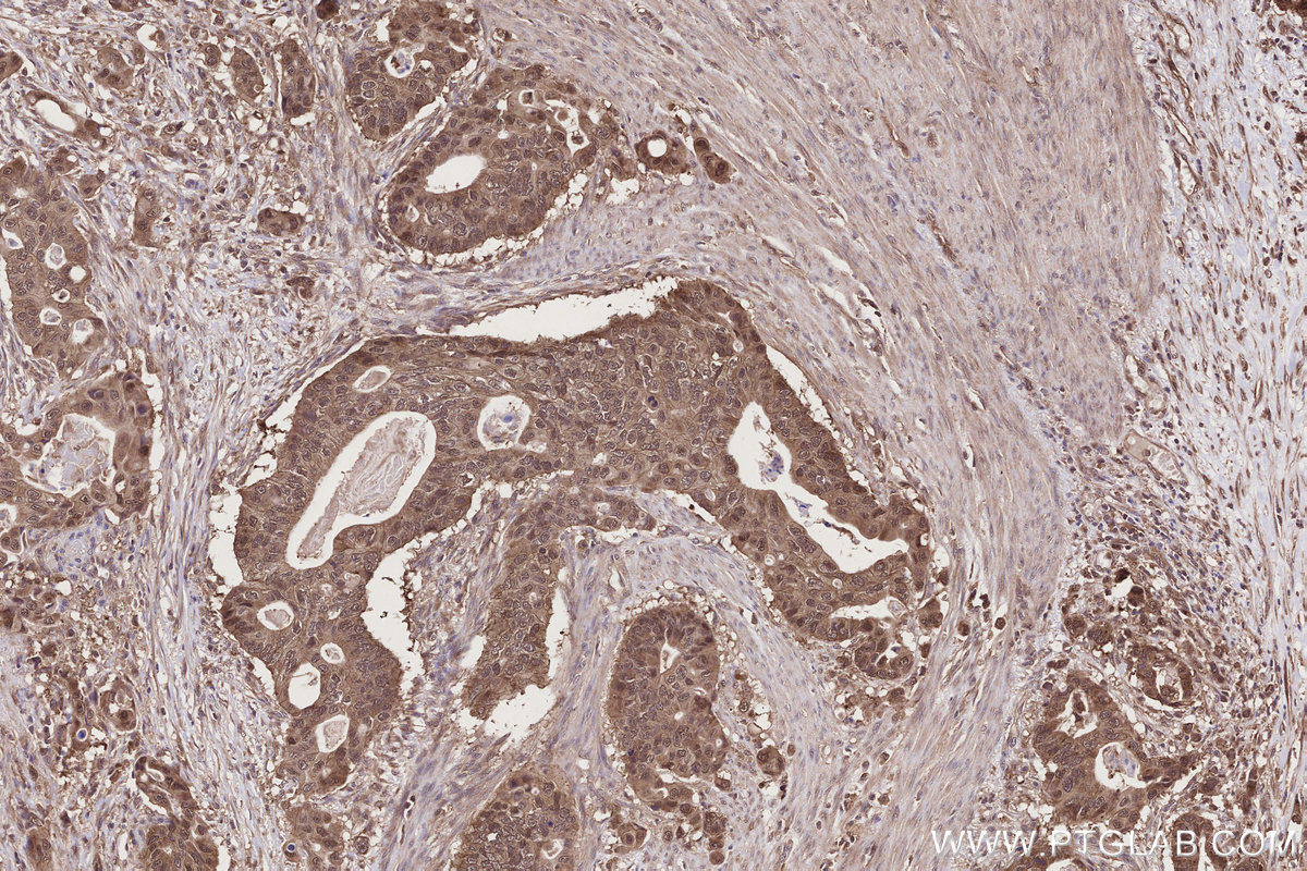 Immunohistochemical analysis of paraffin-embedded human stomach cancer tissue slide using KHC2790 (TRIM11 IHC Kit).
