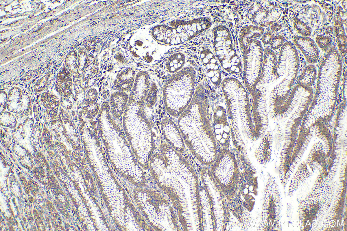 Immunohistochemical analysis of paraffin-embedded human stomach cancer tissue slide using KHC1914 (TRIM15 IHC Kit).