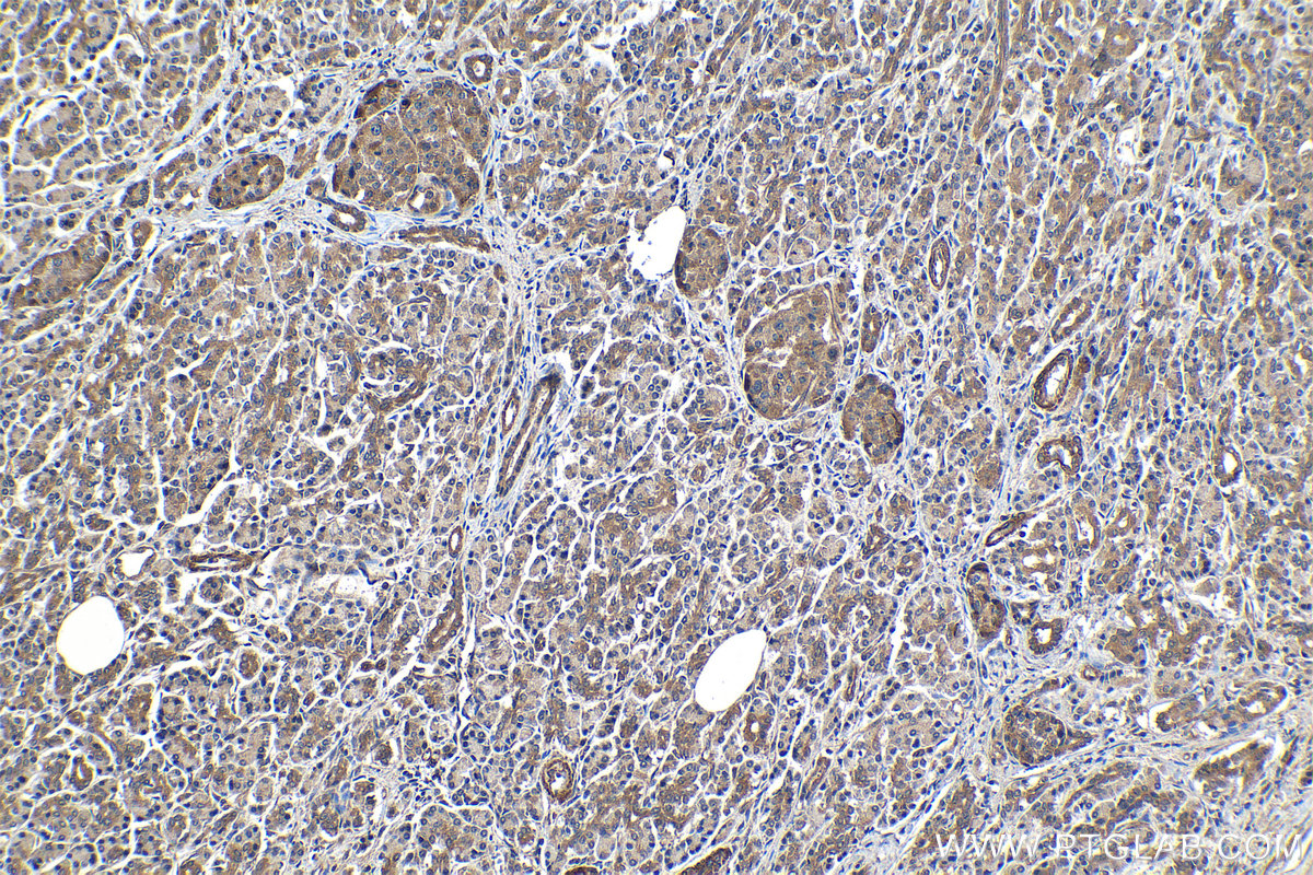 Immunohistochemical analysis of paraffin-embedded human pancreas cancer tissue slide using KHC1177 (TRIM21 IHC Kit).