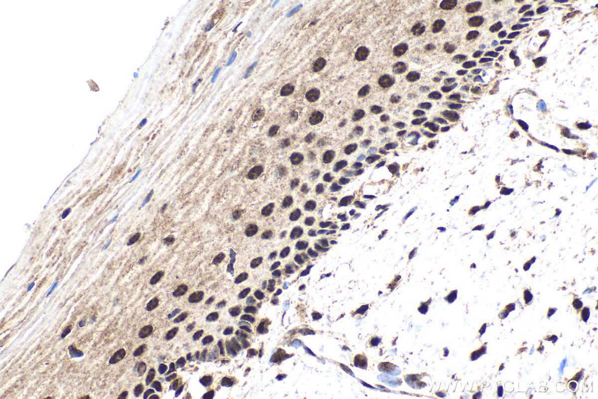 Immunohistochemical analysis of paraffin-embedded human cervical cancer tissue slide using KHC1825 (TRIM22 IHC Kit).