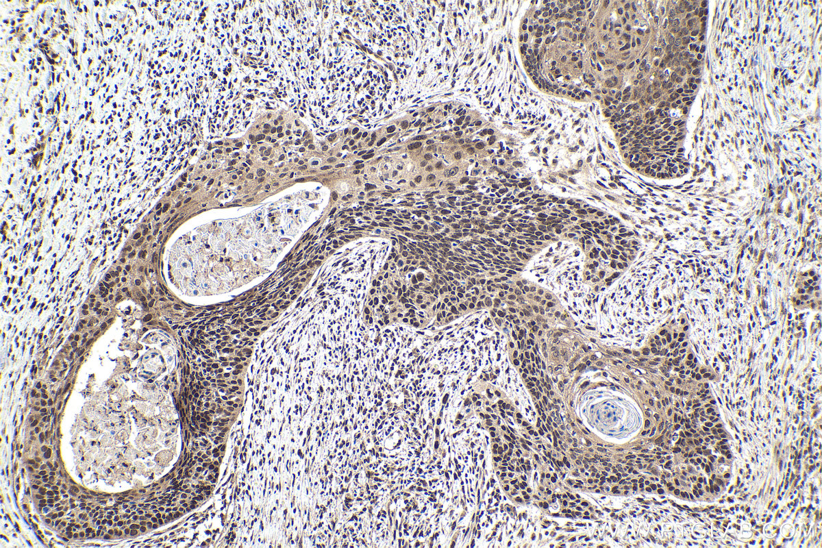 Immunohistochemical analysis of paraffin-embedded human oesophagus cancer tissue slide using KHC1825 (TRIM22 IHC Kit).