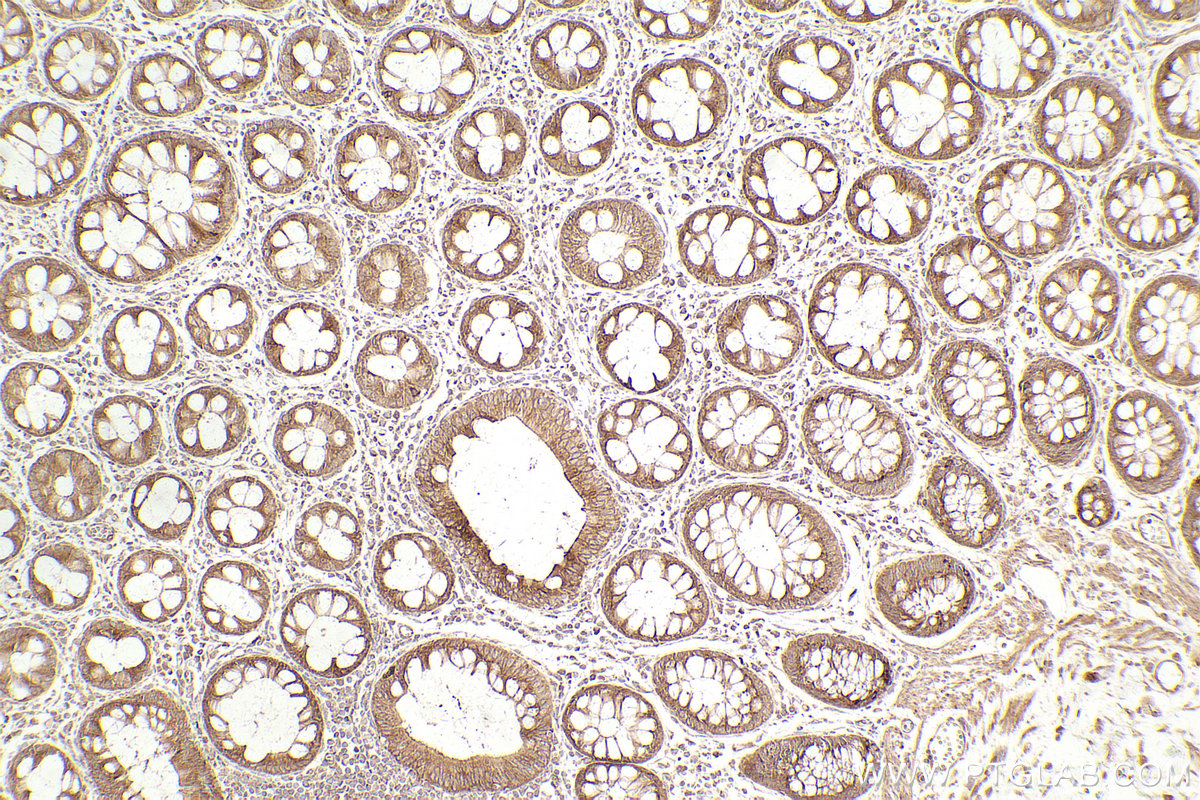Immunohistochemical analysis of paraffin-embedded human rectal cancer tissue slide using KHC2446 (TRIM29 IHC Kit).