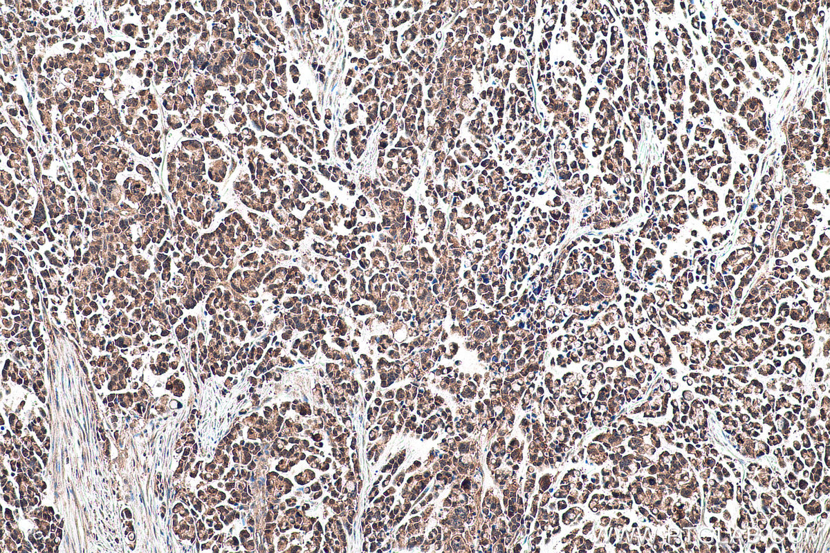 Immunohistochemical analysis of paraffin-embedded human colon cancer tissue slide using KHC0966 (TRIM47 IHC Kit).
