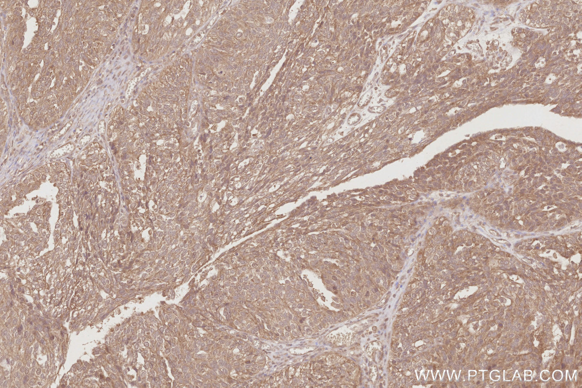 Immunohistochemical analysis of paraffin-embedded human ovary cancer tissue slide using KHC2890 (TRIM5 IHC Kit).