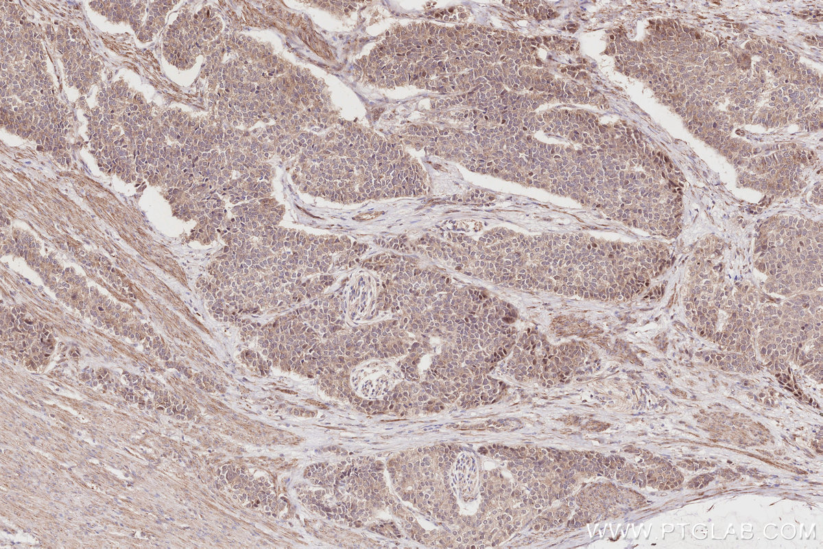 Immunohistochemical analysis of paraffin-embedded human stomach cancer tissue slide using KHC2860 (TRIM56 IHC Kit).