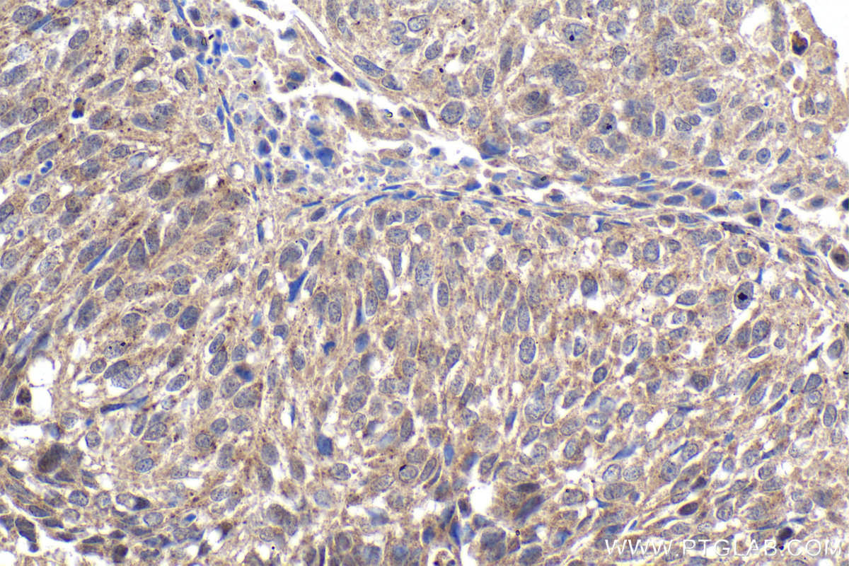 Immunohistochemical analysis of paraffin-embedded human lung cancer tissue slide using KHC1912 (TRIM8 IHC Kit).