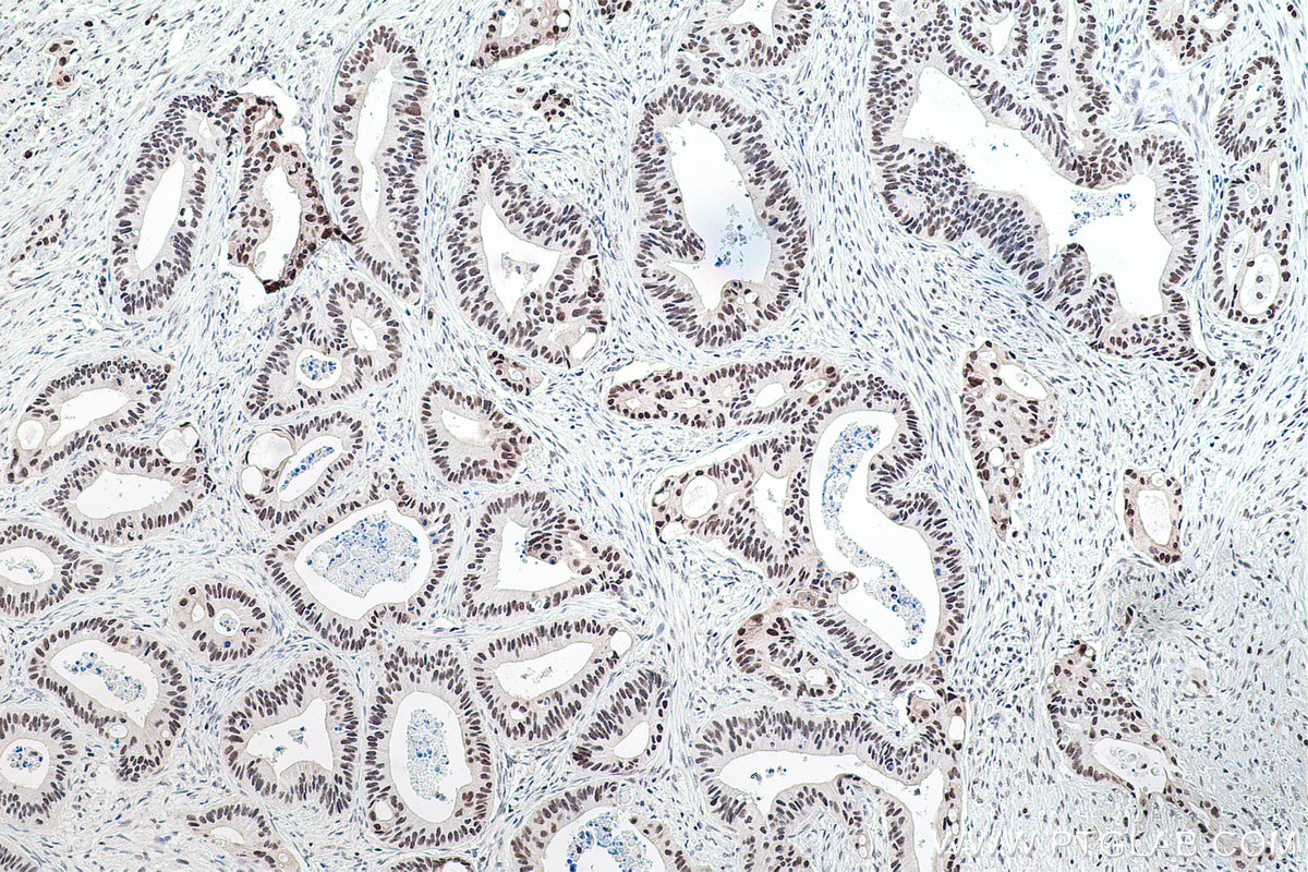 Immunohistochemical analysis of paraffin-embedded human colon cancer tissue slide using KHC0177 (TRMT6 IHC Kit).