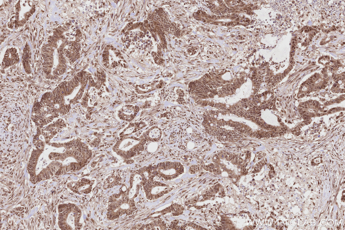 Immunohistochemical analysis of paraffin-embedded human rectal cancer tissue slide using KHC2818 (TRNT1 IHC Kit).