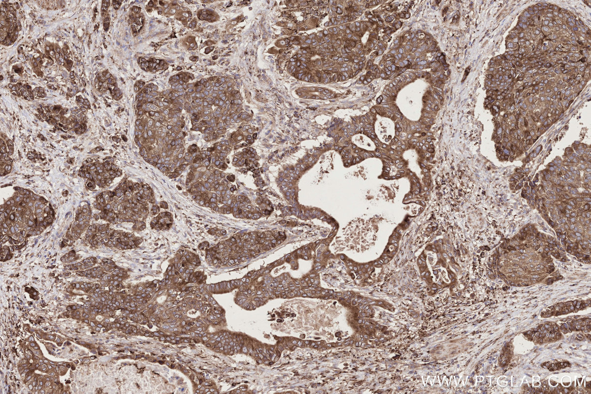 Immunohistochemical analysis of paraffin-embedded human stomach cancer tissue slide using KHC2723 (TRPC4AP IHC Kit).