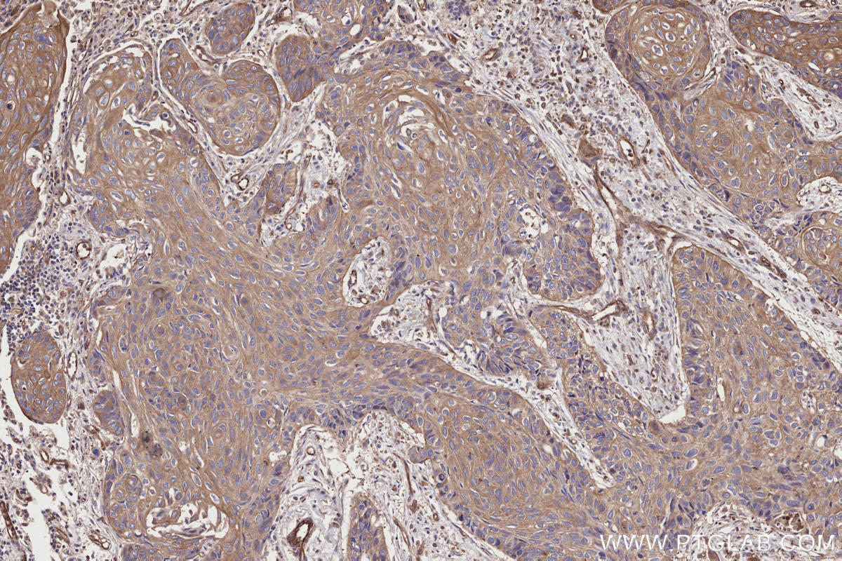 Immunohistochemical analysis of paraffin-embedded human lung cancer tissue slide using KHC2616 (TRPV3 IHC Kit).
