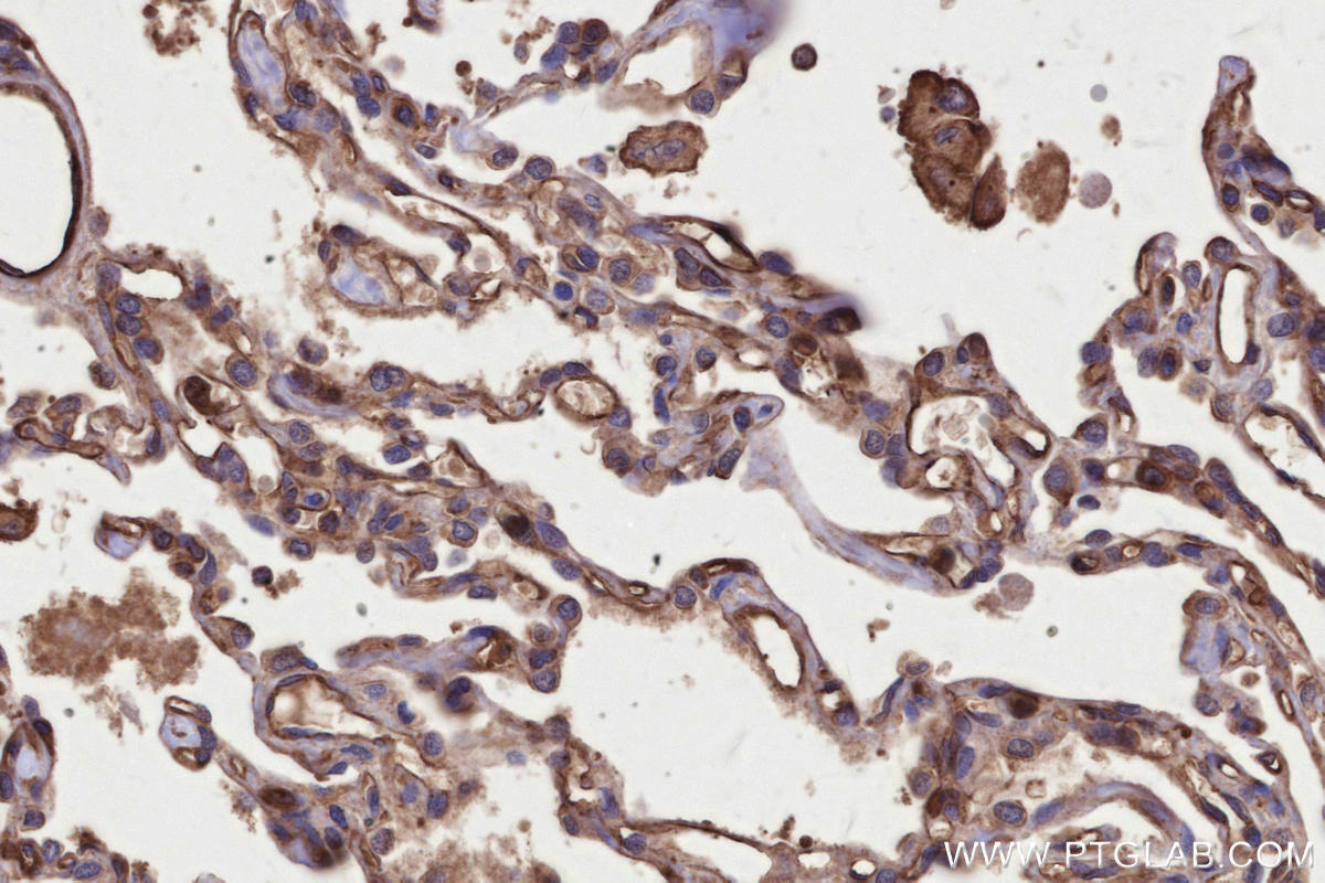 Immunohistochemical analysis of paraffin-embedded human lung cancer tissue slide using KHC2616 (TRPV3 IHC Kit).