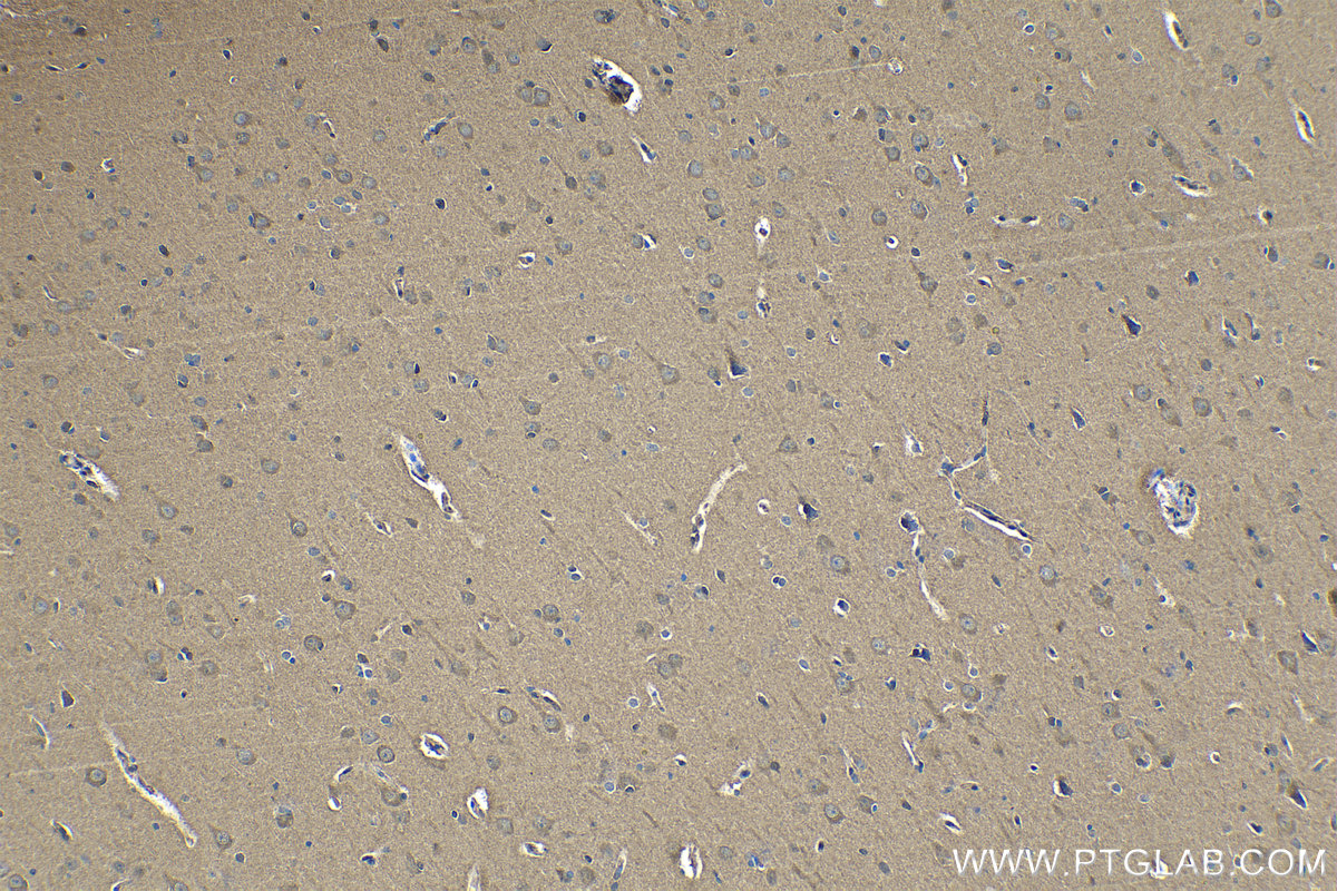 Immunohistochemical analysis of paraffin-embedded human gliomas tissue slide using KHC1341 (TSC22D1 IHC Kit).