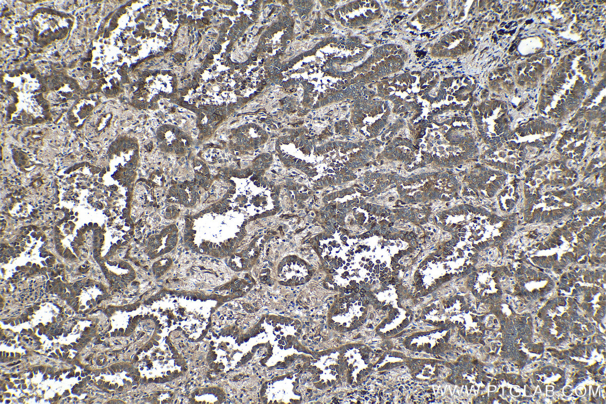 Immunohistochemical analysis of paraffin-embedded human lung cancer tissue slide using KHC1341 (TSC22D1 IHC Kit).