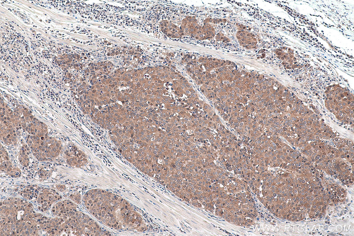 Immunohistochemical analysis of paraffin-embedded human stomach cancer tissue slide using KHC0903 (TSN IHC Kit).