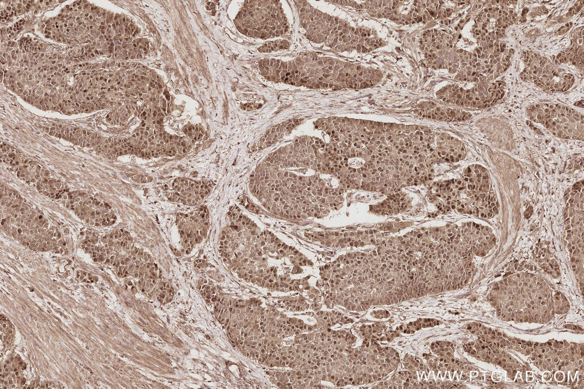 Immunohistochemical analysis of paraffin-embedded human stomach cancer tissue slide using KHC2906 (TSPYL2/CDA1 IHC Kit).