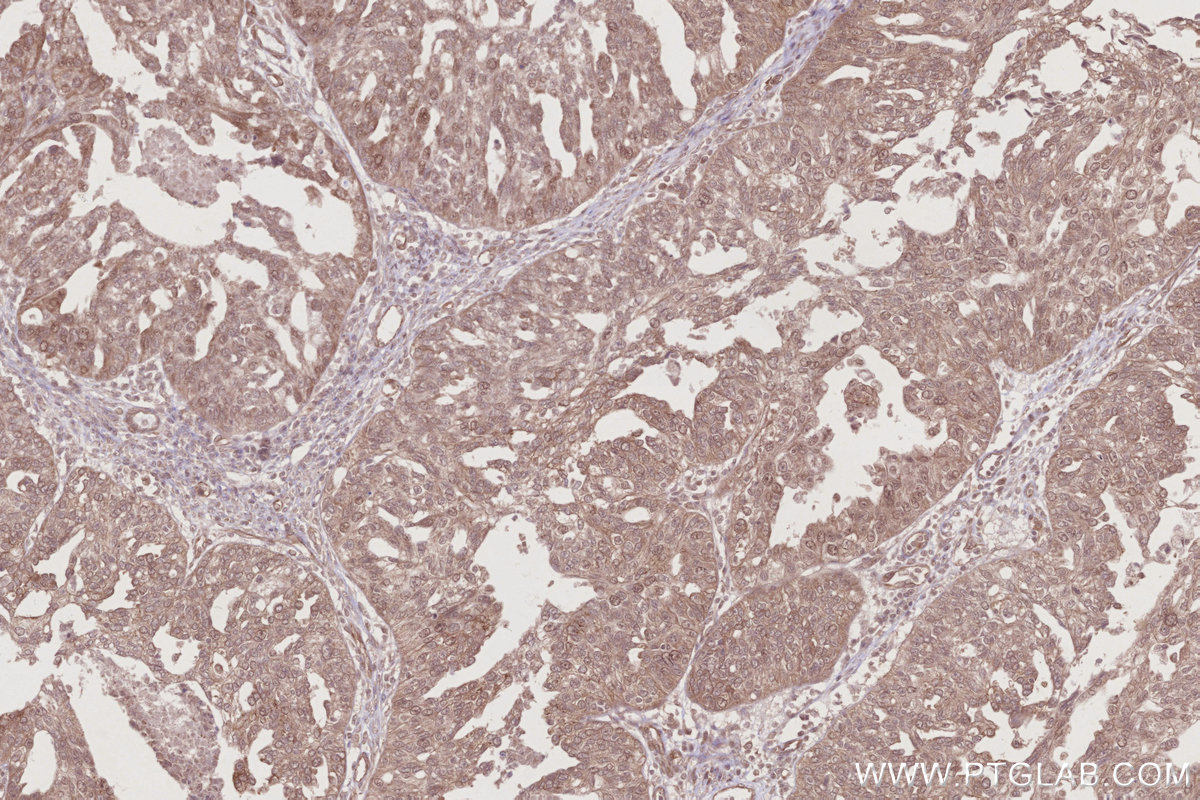 Immunohistochemical analysis of paraffin-embedded human ovary cancer tissue slide using KHC2777 (TTC28 IHC Kit).