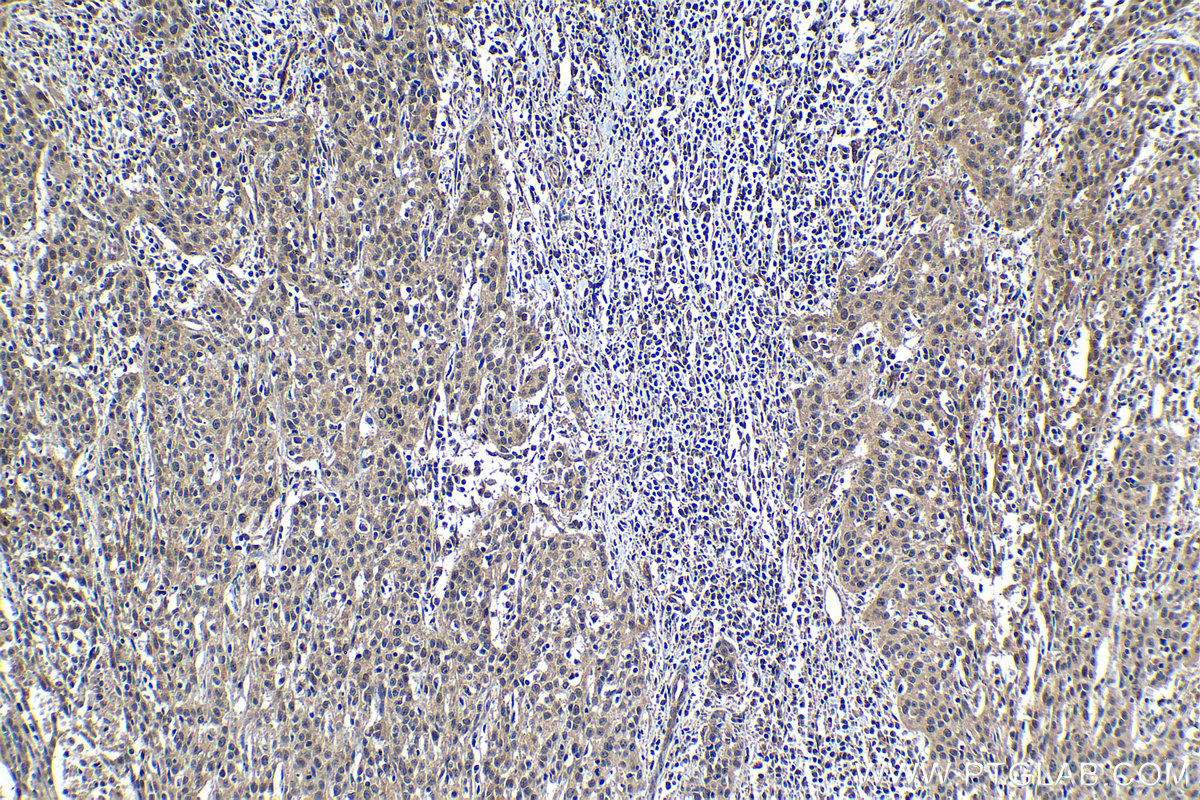 Immunohistochemical analysis of paraffin-embedded human cervical cancer tissue slide using KHC1220 (TTK IHC Kit).