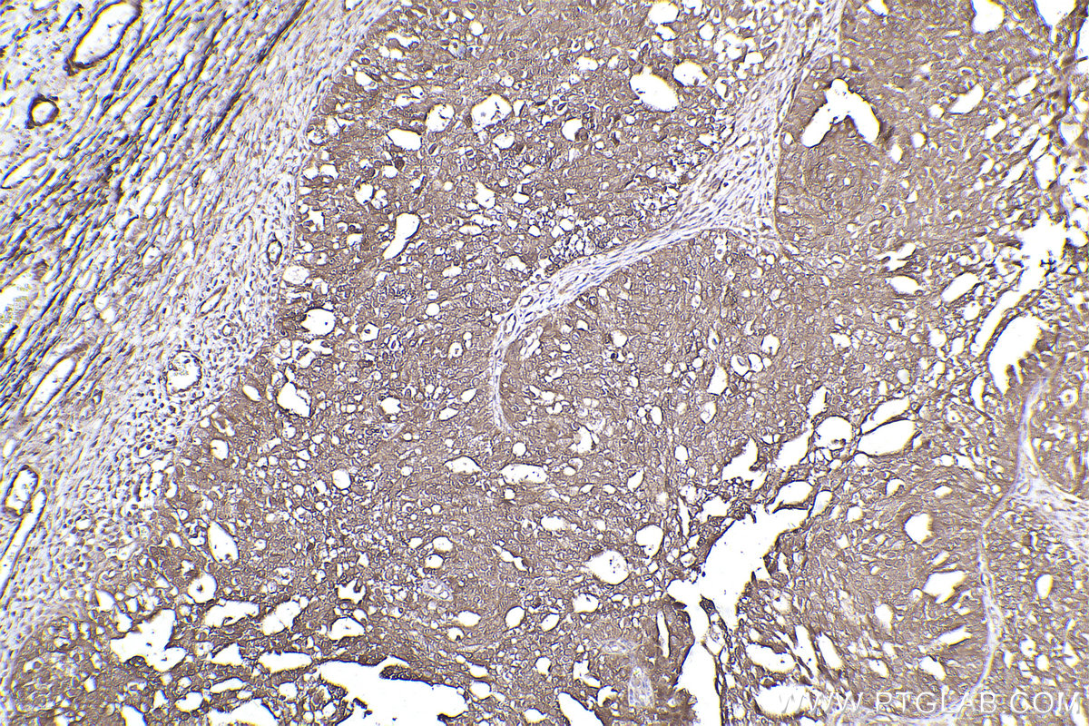 Immunohistochemical analysis of paraffin-embedded human ovary cancer tissue slide using KHC2453 (TTLL12 IHC Kit).