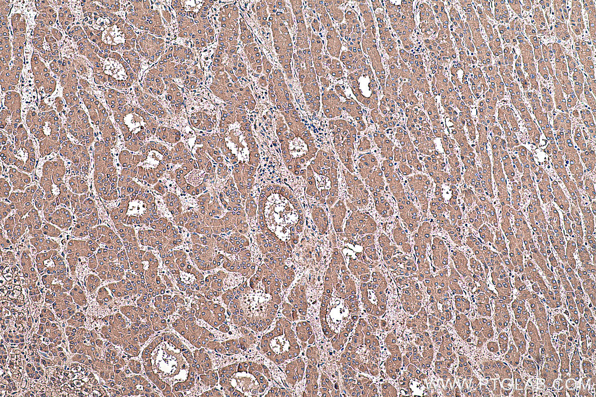 Immunohistochemical analysis of paraffin-embedded human liver cancer tissue slide using KHC0390 (Prealbumin/transthyretin IHC Kit).