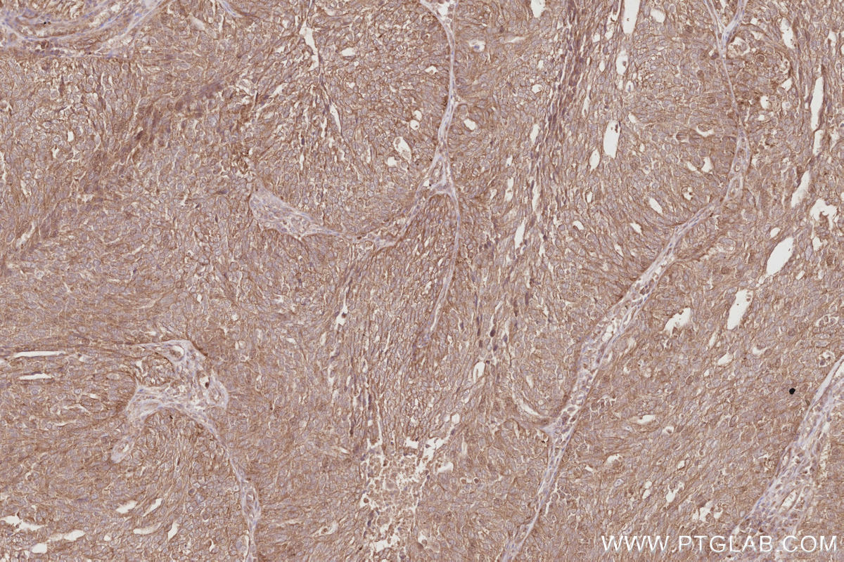 Immunohistochemical analysis of paraffin-embedded human ovary cancer tissue slide using KHC2909 (TTYH1 IHC Kit).