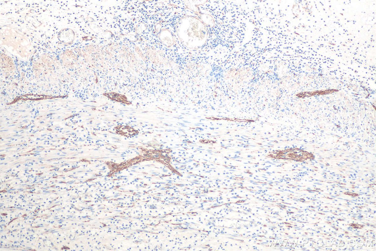 Immunohistochemical analysis of paraffin-embedded human appendicitis tissue slide using KHC0825 (TUBB2B IHC Kit).