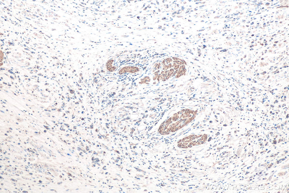 Immunohistochemical analysis of paraffin-embedded human stomach cancer tissue slide using KHC0825 (TUBB2B IHC Kit).