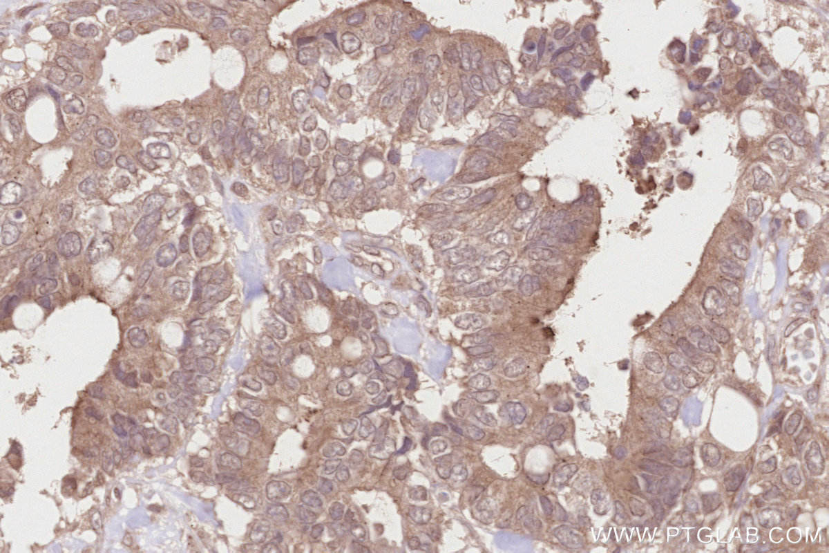Immunohistochemical analysis of paraffin-embedded human rectal cancer tissue slide using KHC2829 (TUBGCP5 IHC Kit).