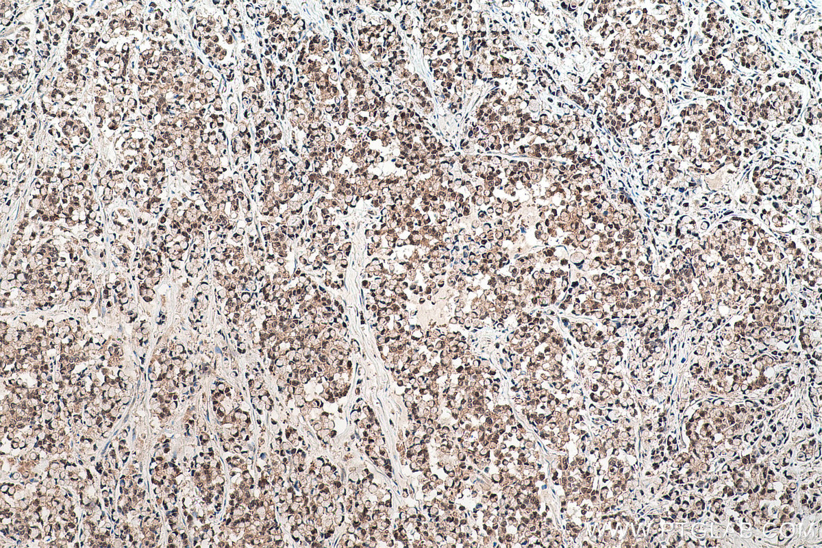 Immunohistochemical analysis of paraffin-embedded human colon cancer tissue slide using KHC0529 (TXN IHC Kit).