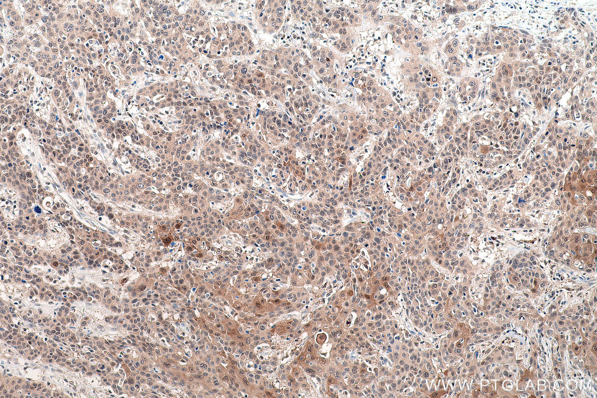 Immunohistochemical analysis of paraffin-embedded human oesophagus cancer tissue slide using KHC0529 (TXN IHC Kit).