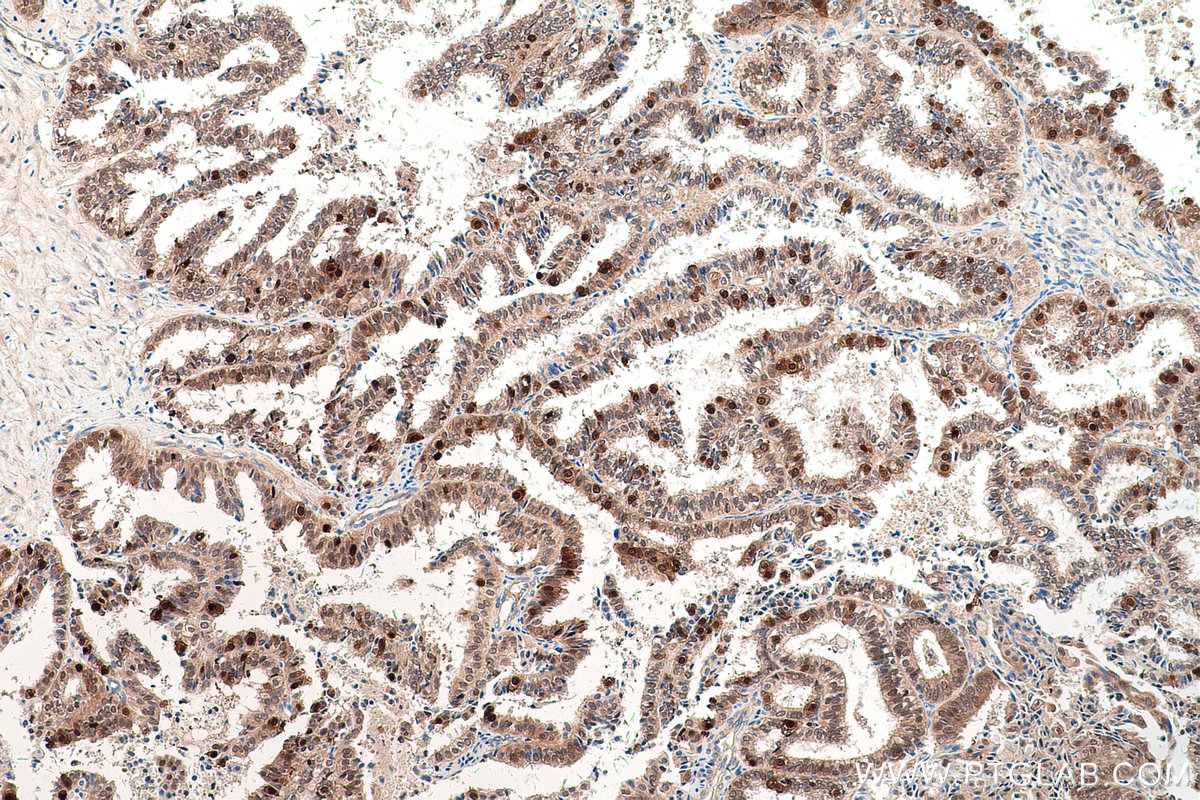 Immunohistochemical analysis of paraffin-embedded human ovary tumor tissue slide using KHC0529 (TXN IHC Kit).