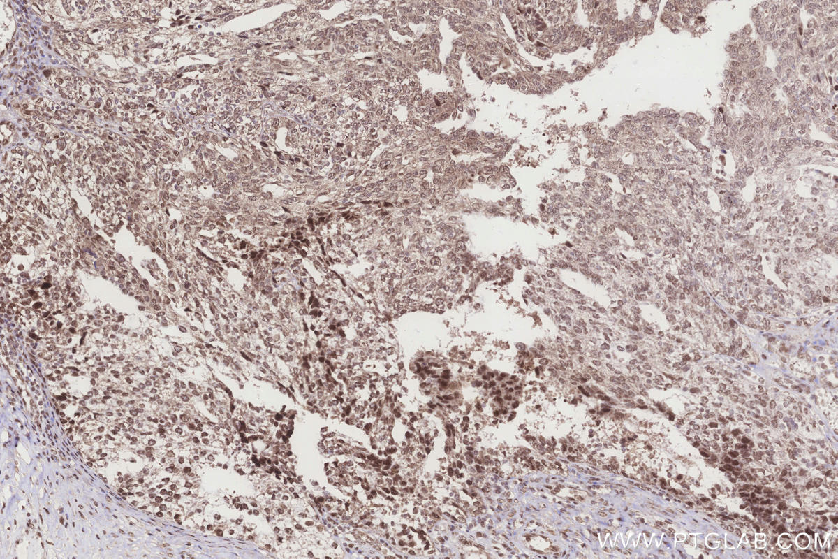 Immunohistochemical analysis of paraffin-embedded human ovary cancer tissue slide using KHC3283 (TXNRD3 IHC Kit).