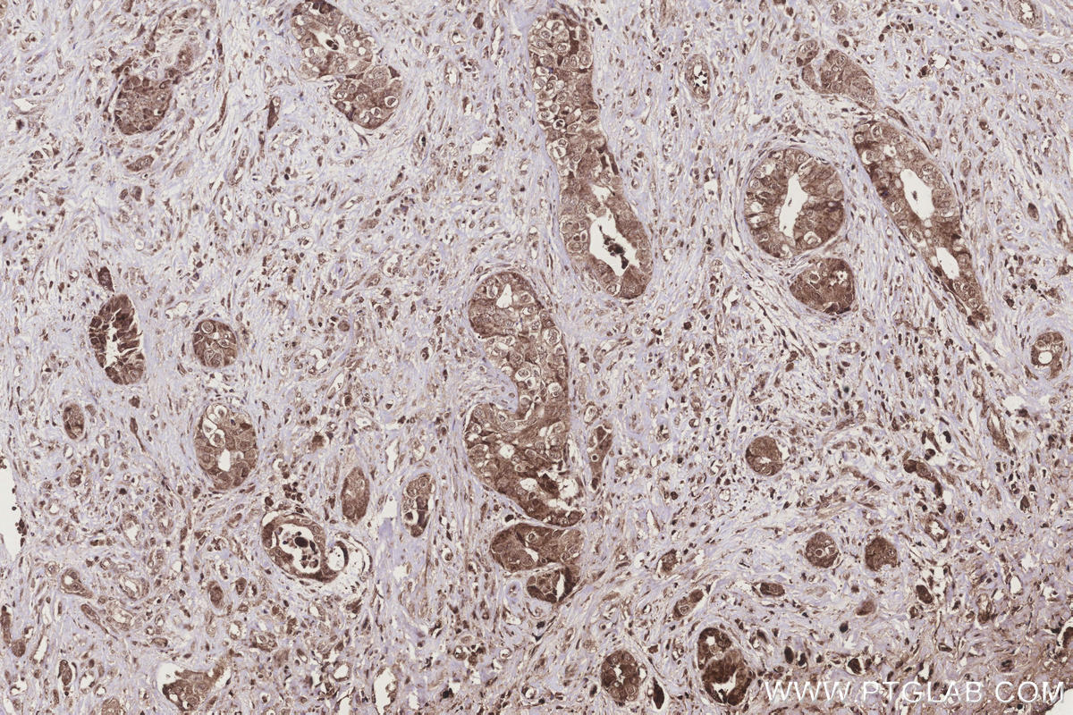 Immunohistochemical analysis of paraffin-embedded human pancreas cancer tissue slide using KHC3283 (TXNRD3 IHC Kit).