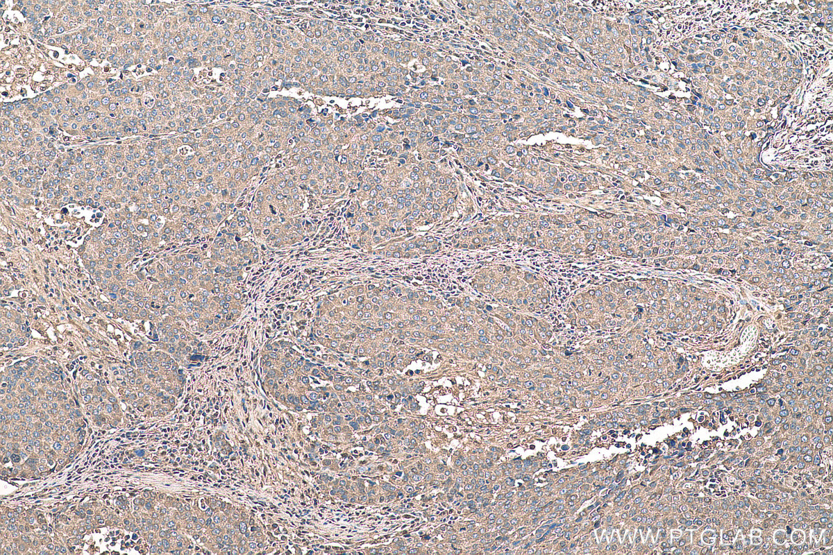 Immunohistochemical analysis of paraffin-embedded human stomach cancer tissue slide using KHC0926 (TYMP IHC Kit).